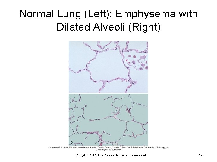 Normal Lung (Left); Emphysema with Dilated Alveoli (Right) Copyright © 2019 by Elsevier Inc.