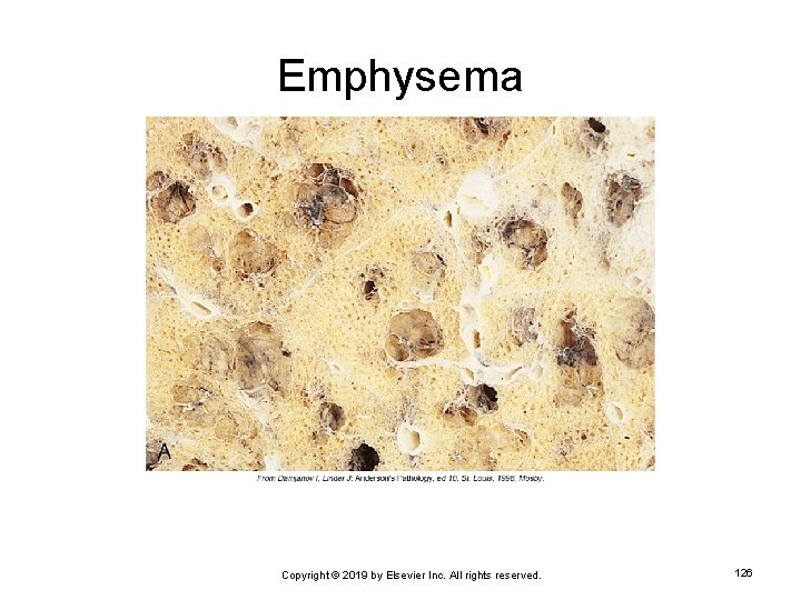 Emphysema Copyright © 2019 by Elsevier Inc. All rights reserved. 126 
