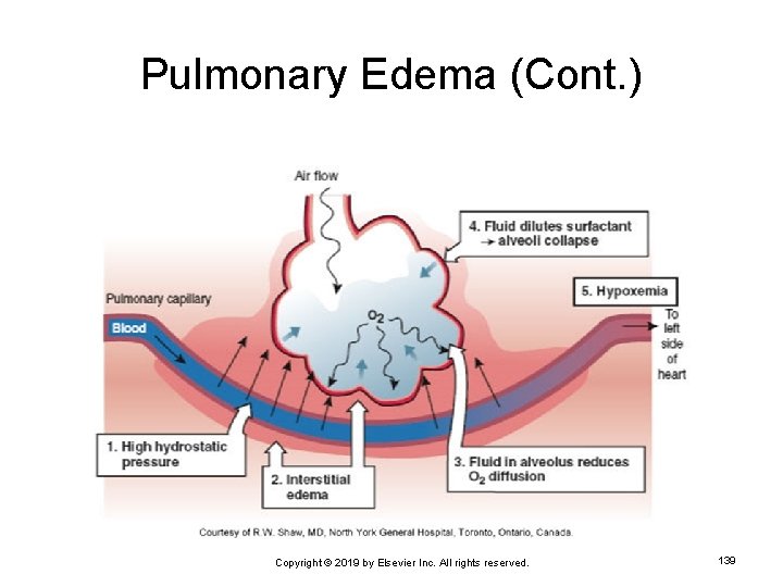 Pulmonary Edema (Cont. ) Copyright © 2019 by Elsevier Inc. All rights reserved. 139