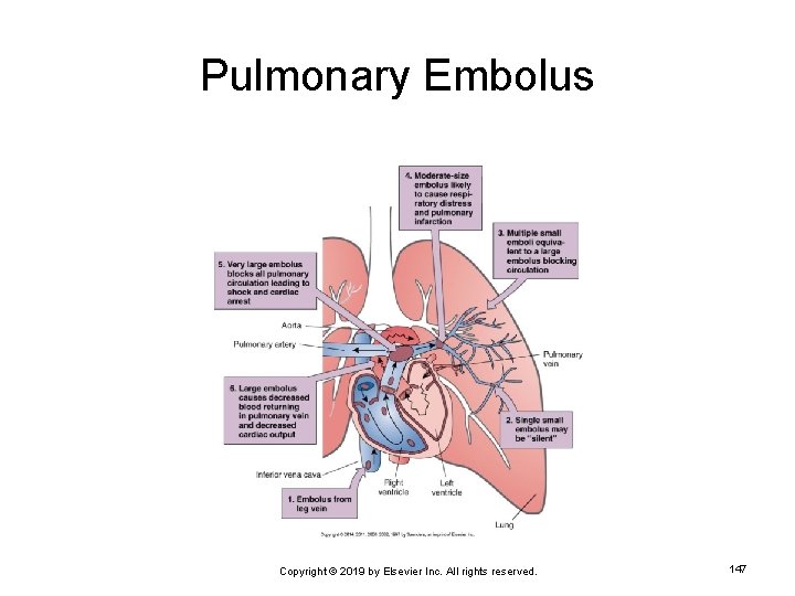 Pulmonary Embolus Copyright © 2019 by Elsevier Inc. All rights reserved. 147 
