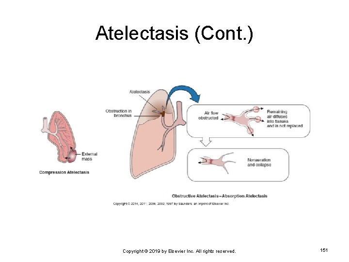 Atelectasis (Cont. ) Copyright © 2019 by Elsevier Inc. All rights reserved. 151 