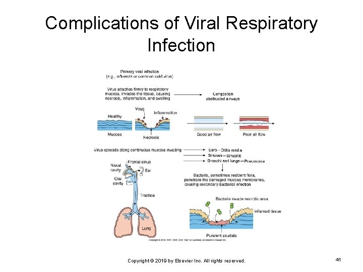 Complications of Viral Respiratory Infection Copyright © 2019 by Elsevier Inc. All rights reserved.