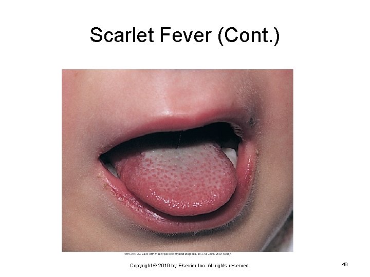 Scarlet Fever (Cont. ) Copyright © 2019 by Elsevier Inc. All rights reserved. 49
