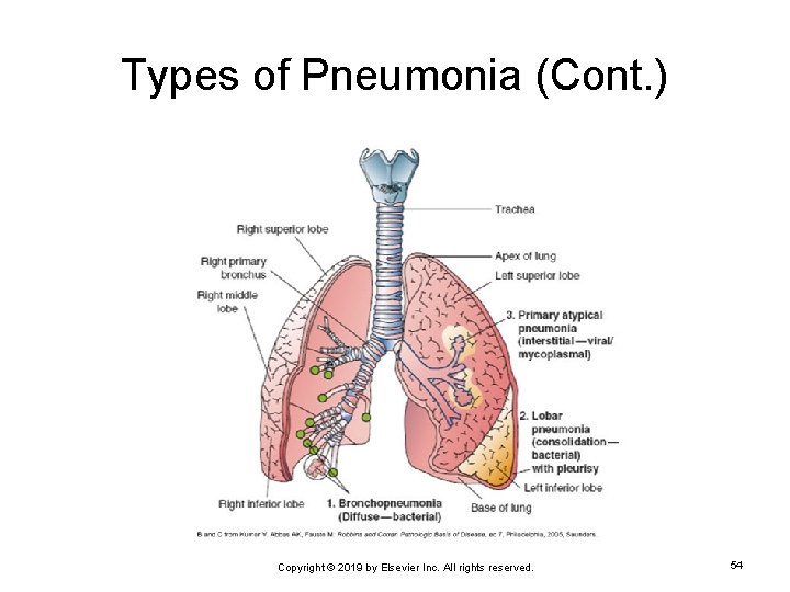 Types of Pneumonia (Cont. ) Copyright © 2019 by Elsevier Inc. All rights reserved.