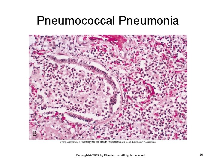 Pneumococcal Pneumonia Copyright © 2019 by Elsevier Inc. All rights reserved. 56 