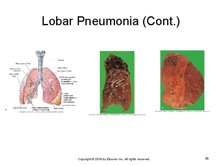 Lobar Pneumonia (Cont. ) Copyright © 2019 by Elsevier Inc. All rights reserved. 58