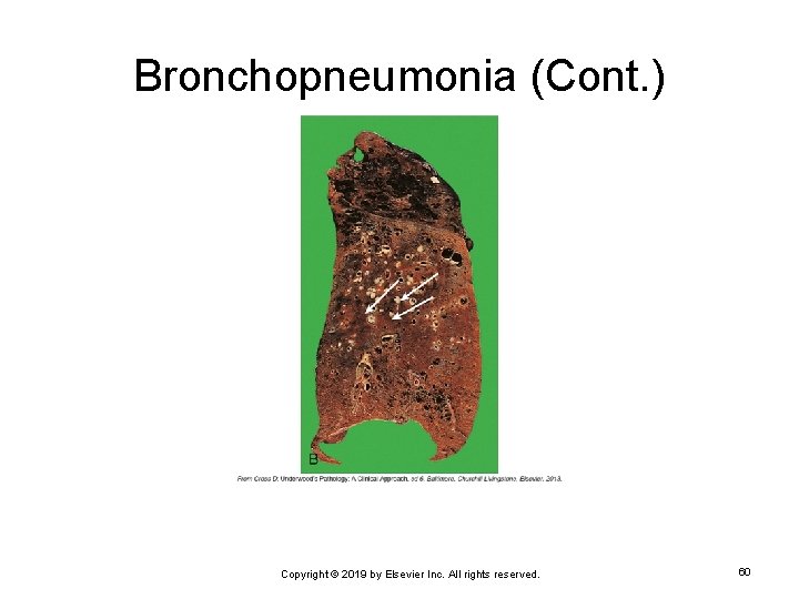 Bronchopneumonia (Cont. ) Copyright © 2019 by Elsevier Inc. All rights reserved. 60 