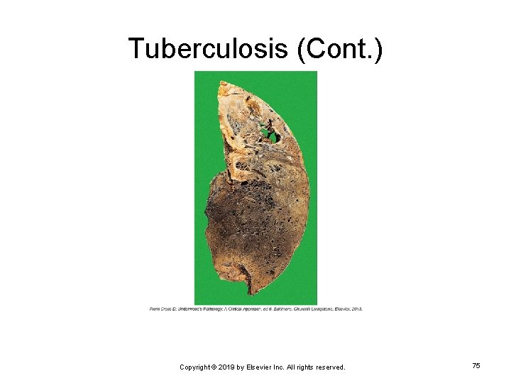 Tuberculosis (Cont. ) Copyright © 2019 by Elsevier Inc. All rights reserved. 75 