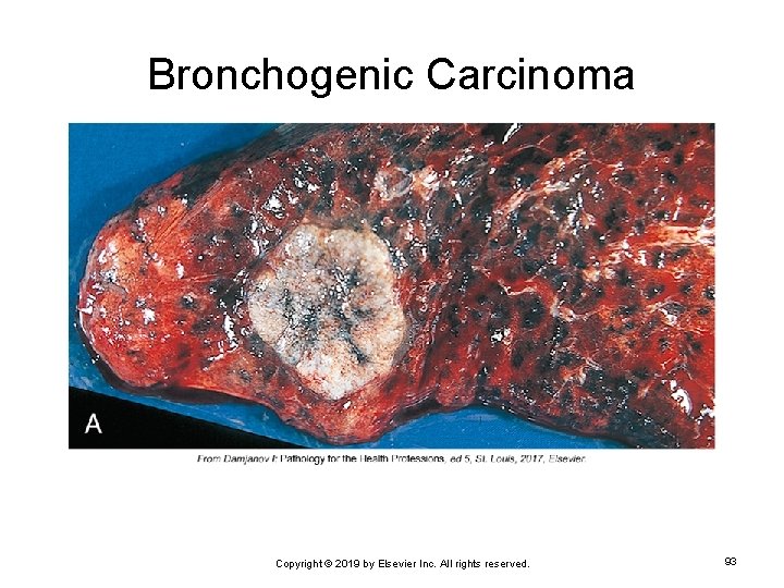 Bronchogenic Carcinoma Copyright © 2019 by Elsevier Inc. All rights reserved. 93 