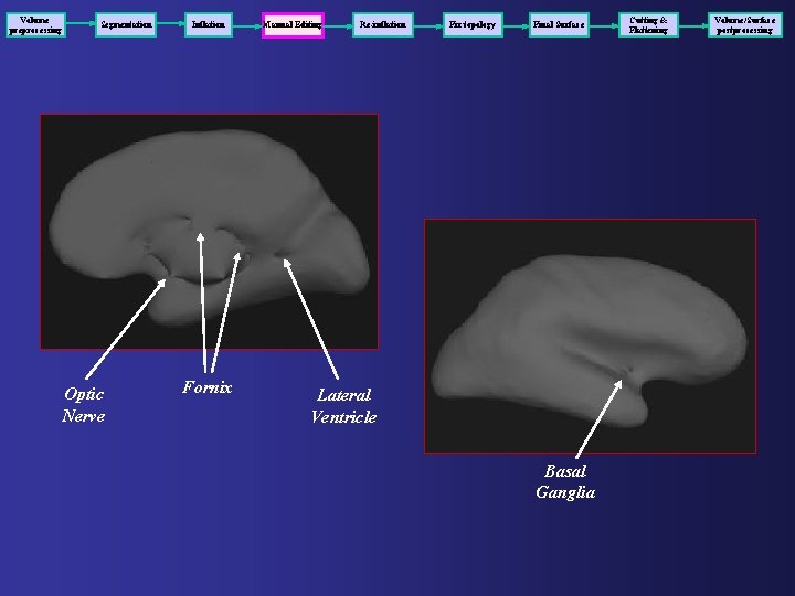 Volume preprocessing Segmentation Optic Nerve Inflation Fornix Manual Editing Re-inflation Fix topology Final Surface