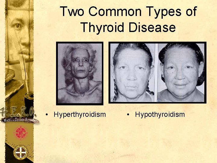 Two Common Types of Thyroid Disease • Hyperthyroidism • Hypothyroidism 