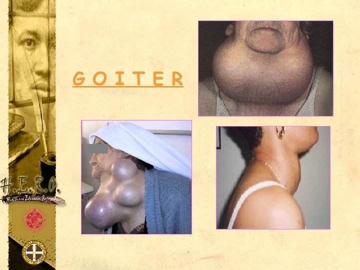 G O I T E R 