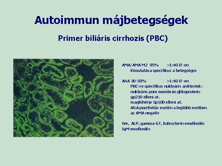 Autoimmun májbetegségek Primer biliáris cirrhozis (PBC) AMA/AMA M 2 95% >1: 40 IF-en Kimutatása