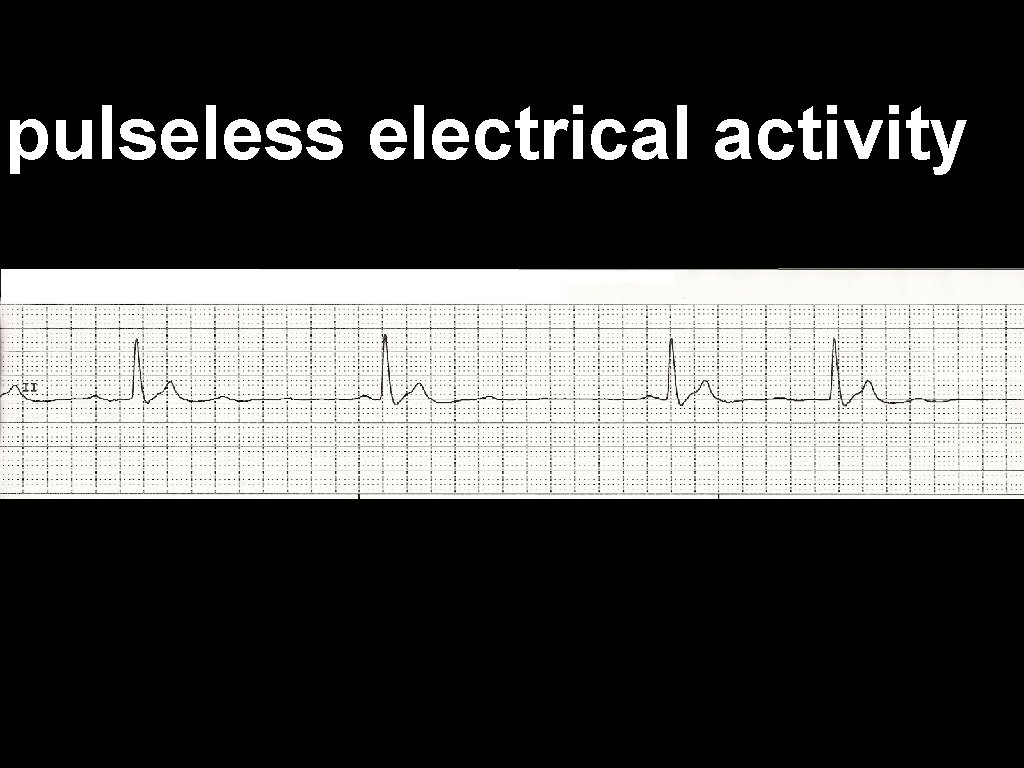 pulseless electrical activity 