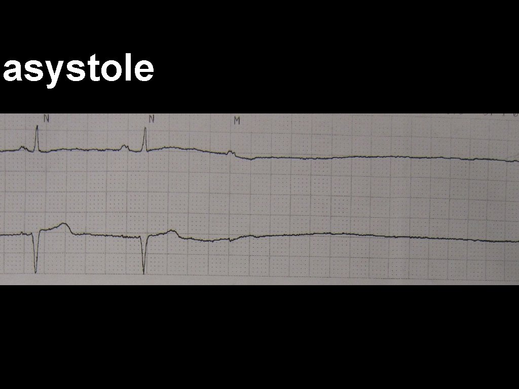 asystole 