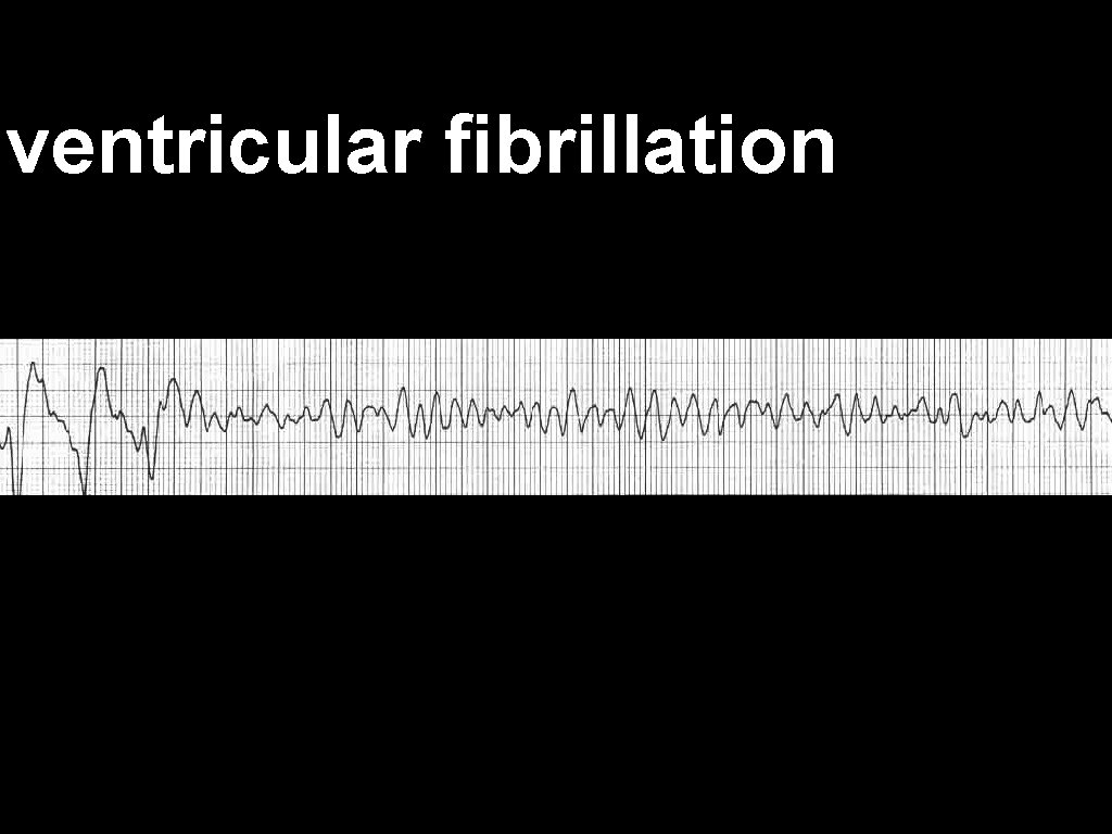 ventricular fibrillation 