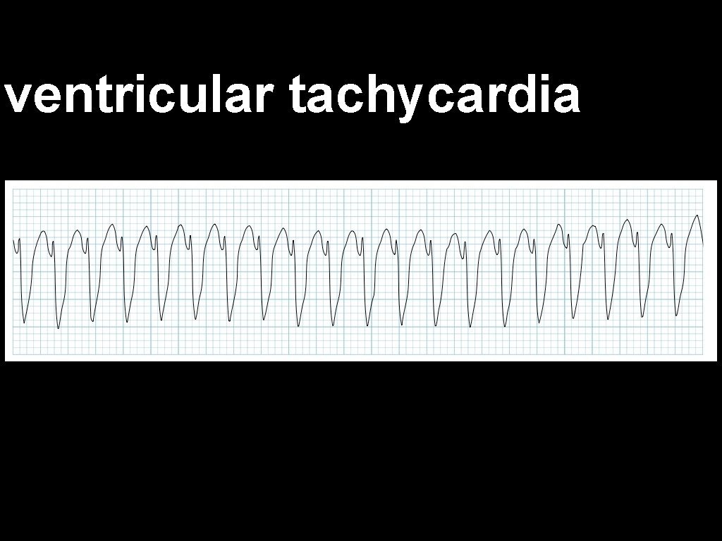 ventricular tachycardia 