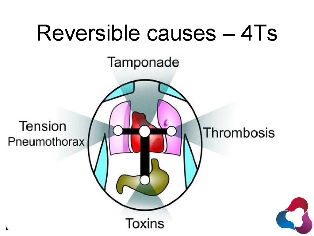 Reversible causes – 4 Ts 