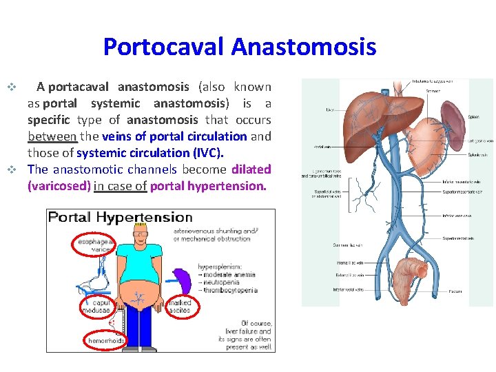 Portocaval Anastomosis A portacaval anastomosis (also known as portal systemic anastomosis) is a specific