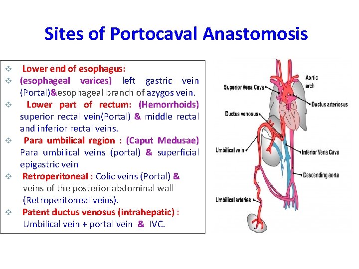 Sites of Portocaval Anastomosis v v v Lower end of esophagus: (esophageal varices) left