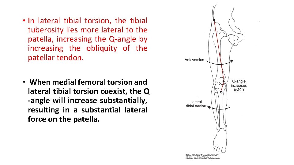  • In lateral tibial torsion, the tibial tuberosity lies more lateral to the