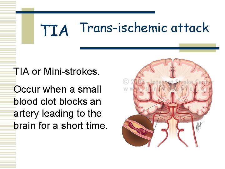 TIA Trans-ischemic attack TIA or Mini-strokes. Occur when a small blood clot blocks an