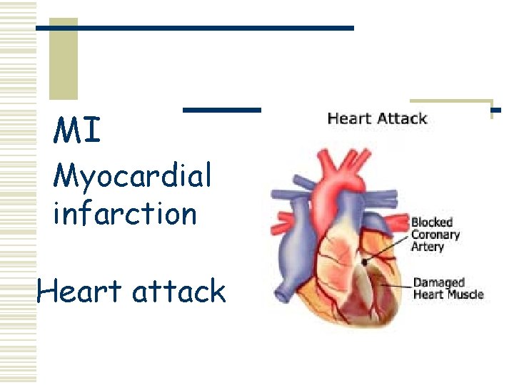 MI Myocardial infarction Heart attack 