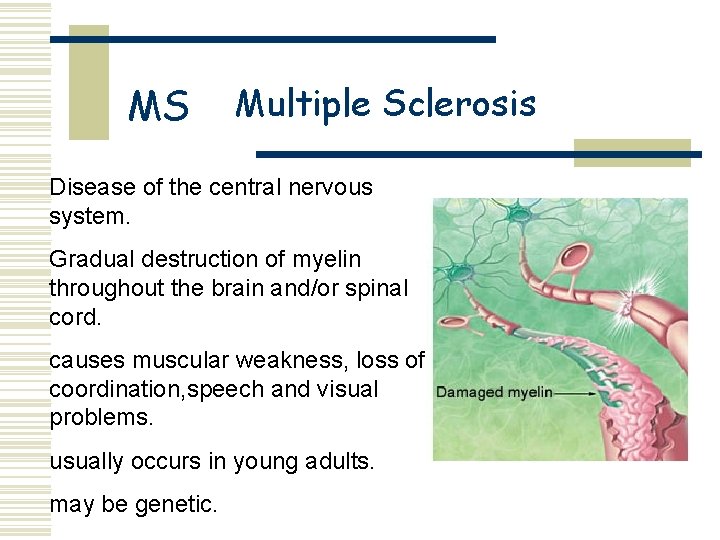 MS Multiple Sclerosis Disease of the central nervous system. Gradual destruction of myelin throughout