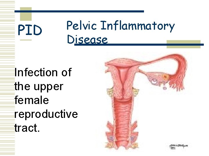 PID Pelvic Inflammatory Disease Infection of the upper female reproductive tract. 