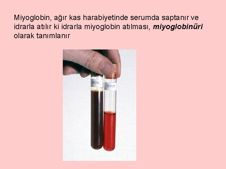 Miyoglobin, ağır kas harabiyetinde serumda saptanır ve idrarla atılır ki idrarla miyoglobin atılması, miyoglobinüri