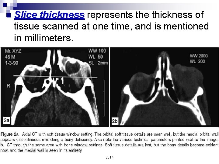 n Slice thickness represents the thickness of tissue scanned at one time, and is