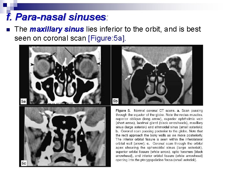 f. Para-nasal sinuses: n The maxillary sinus lies inferior to the orbit, and is