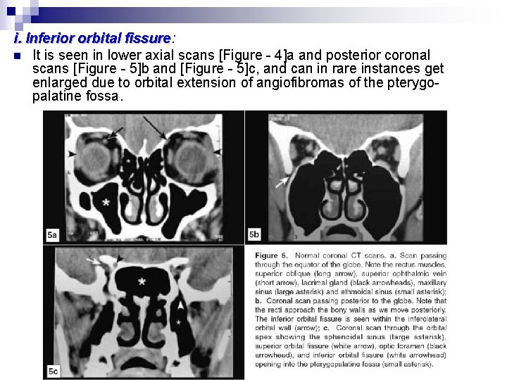 i. Inferior orbital fissure: fissure n It is seen in lower axial scans [Figure
