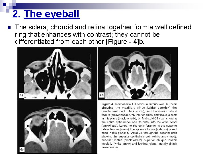 2. The eyeball n The sclera, choroid and retina together form a well defined