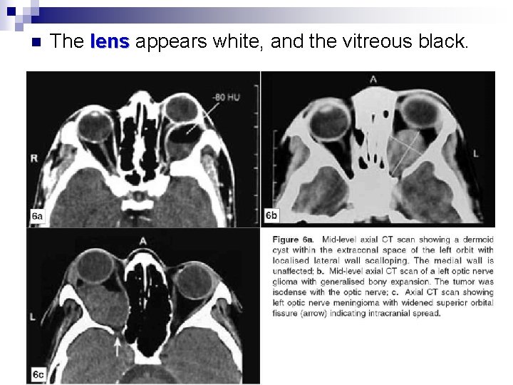 n The lens appears white, and the vitreous black. 2014 