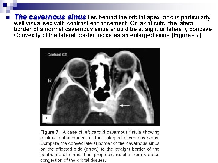 n The cavernous sinus lies behind the orbital apex, and is particularly well visualised
