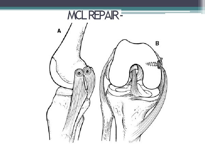 MCL REPAIR- 