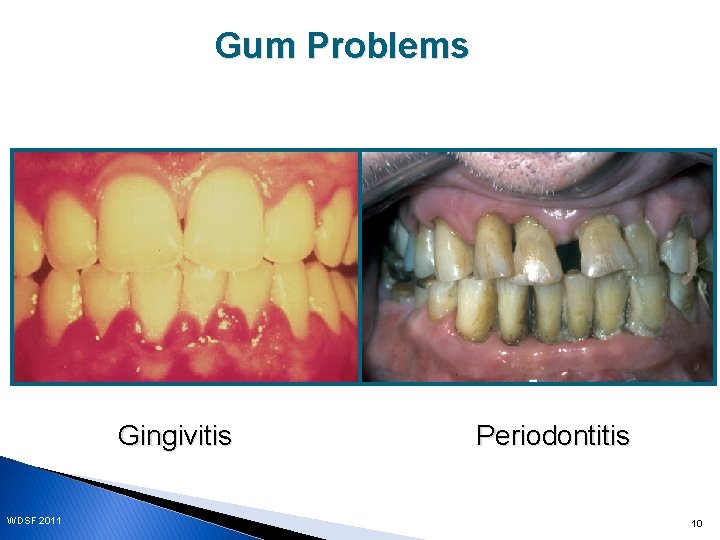 Gum Problems Gingivitis WDSF 2011 Periodontitis 10 