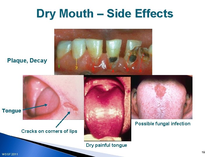 Dry Mouth – Side Effects Plaque, Decay Tongue Possible fungal infection Cracks on corners