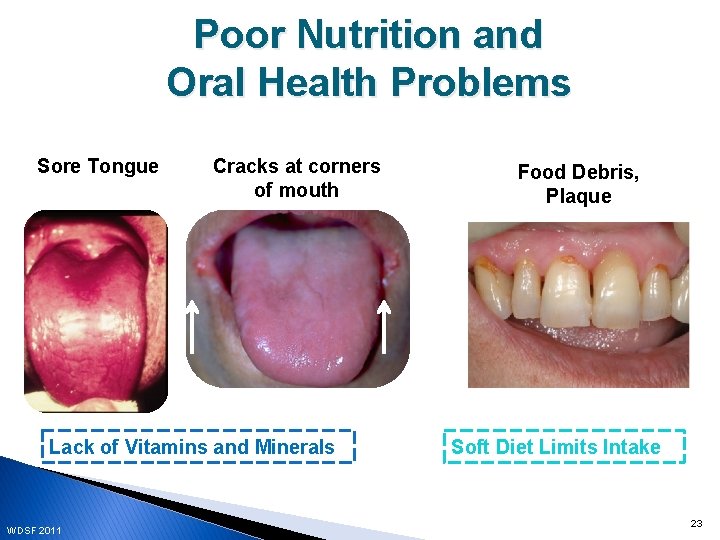 Poor Nutrition and Oral Health Problems Sore Tongue Cracks at corners of mouth Lack