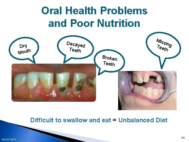 Oral Health Problems and Poor Nutrition Dry Mouth Mis sing Tee th Decaye d