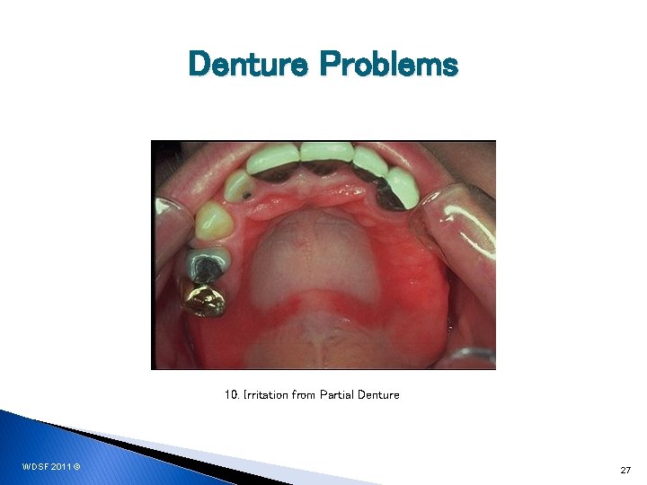 Denture Problems 10. Irritation from Partial Denture WDSF 2011 © 27 