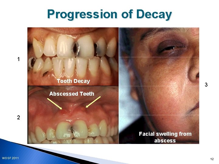 Progression of Decay 1 Tooth Decay 3 Abscessed Teeth 2 Facial swelling from abscess