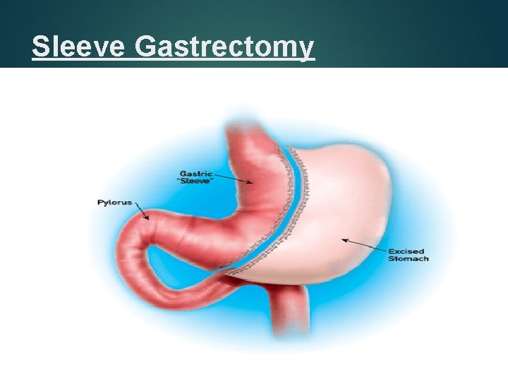 Sleeve Gastrectomy 