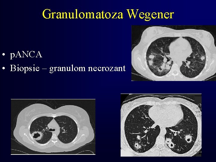 Granulomatoza Wegener • p. ANCA • Biopsie – granulom necrozant 