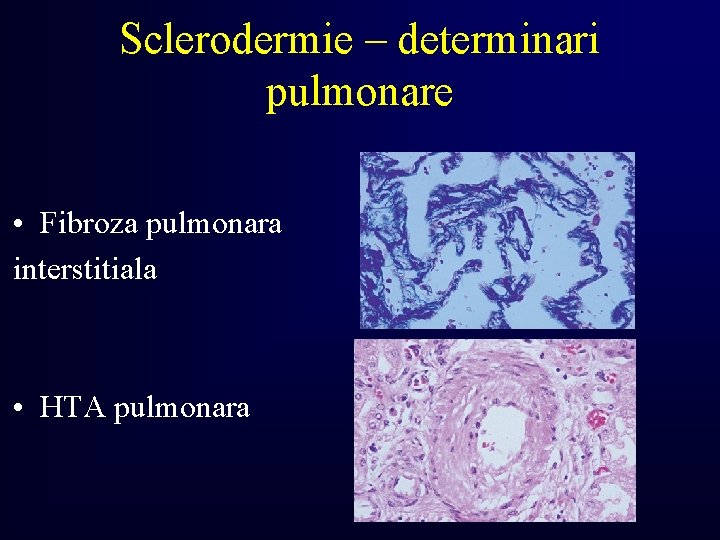 Sclerodermie – determinari pulmonare • Fibroza pulmonara interstitiala • HTA pulmonara 