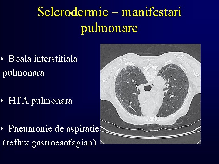 Sclerodermie – manifestari pulmonare • Boala interstitiala pulmonara • HTA pulmonara • Pneumonie de