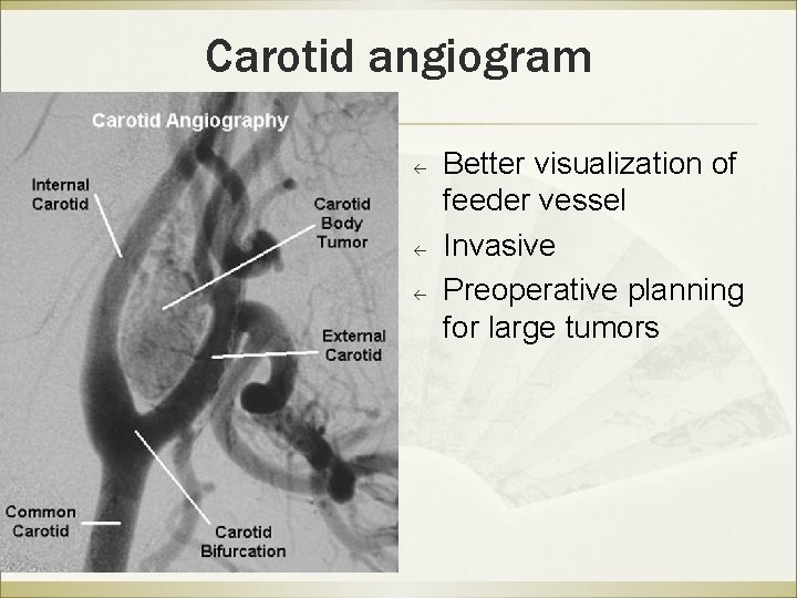Carotid angiogram ß ß ß Better visualization of feeder vessel Invasive Preoperative planning for