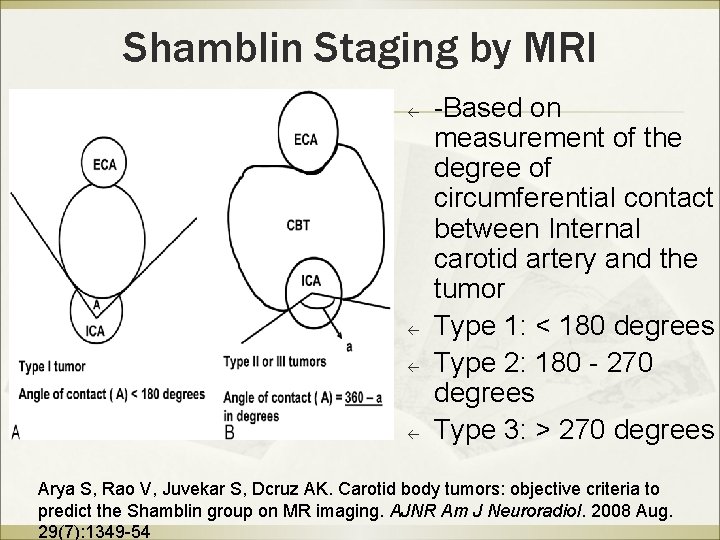 Shamblin Staging by MRI ß ß -Based on measurement of the degree of circumferential