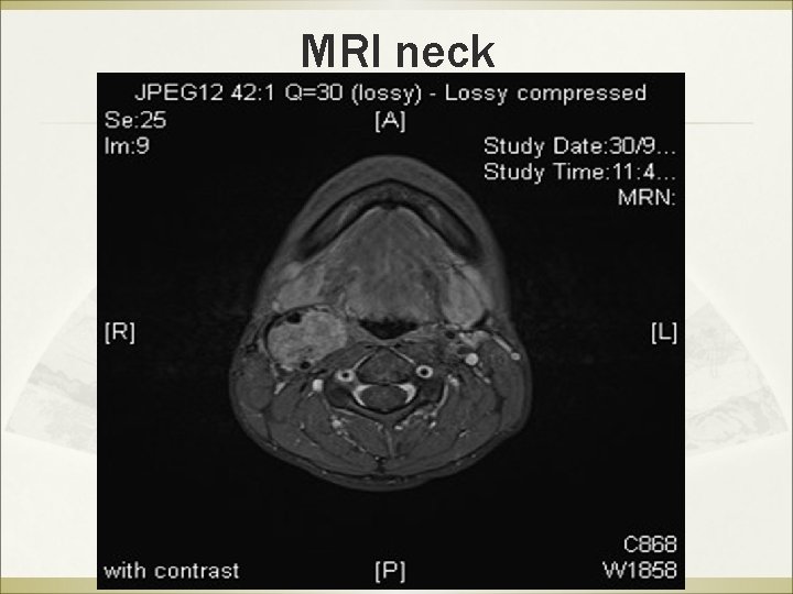 MRI neck 